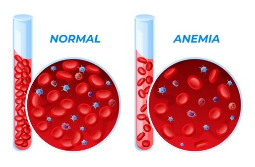 Mengenal Anemia dan Penyebabnya